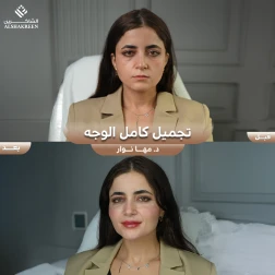 <p>تجميل كامل الوجه&nbsp;</p>