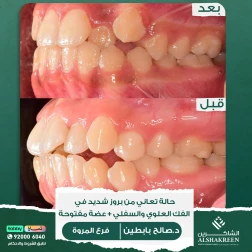<p>&nbsp;</p>

<p>حالة تعاني من بروز شديد في الفك العلوي والسفلي + عضة مفتوحة<br />
تم علاج الحالة خلال ١٦ شهر<br />
والنتيجة مثالية الحمدلله</p>