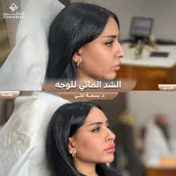 <p>الشد المائي للوجه&nbsp;</p>