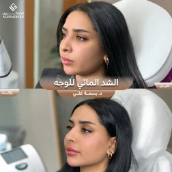 <p>الشد المائي للوجه&nbsp;</p>
