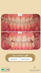 <p>حالات قبل وبعد - تقويم أسنان</p>