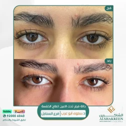 <p>حالة فيلر تحت العين لعلاج الخفسة<br />
&nbsp;</p>