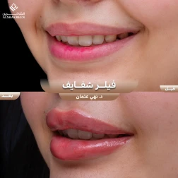 <p>فيلر شفايف&nbsp;</p>
