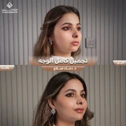 <p>تجميل كامل الوجه&nbsp;</p>