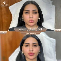 <p>الشد المائي للوجه&nbsp;</p>