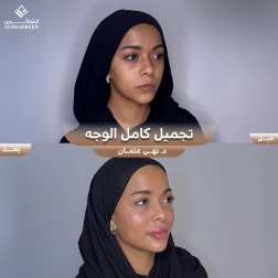 <p>تجميل كامل الوجه&nbsp;</p>