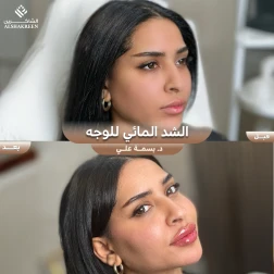 <p>الشد المائي للوجه&nbsp;</p>