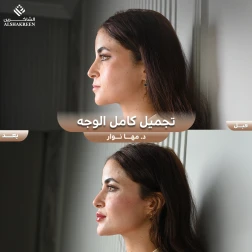 <p>تجميل كامل الوجه&nbsp;</p>