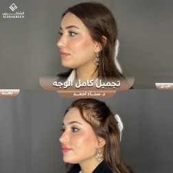 <p>تجميل كامل الوجه&nbsp;</p>