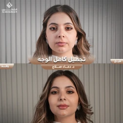 <p>تجميل كامل الوجه&nbsp;</p>
