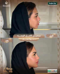 <p>تجميل كامل الوجه&nbsp;</p>