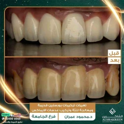 <p>تغيرات تركيبات بورسلين قديمة ومعالجة للثة وتركيب عدسات الايماكس</p>