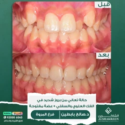 <p>&nbsp;</p>

<p>حالة تعاني من بروز شديد في الفك العلوي والسفلي + عضة مفتوحة<br />
تم علاج الحالة خلال ١٦ شهر<br />
والنتيجة مثالية الحمدلله</p>