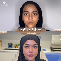 <p>تجميل كامل الوجه&nbsp;</p>