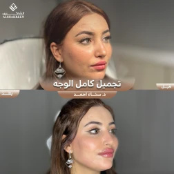 <p>تجميل كامل الوجه&nbsp;</p>