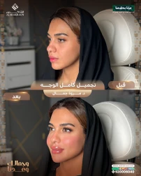 <p>تجميل كامل الوجه&nbsp;</p>