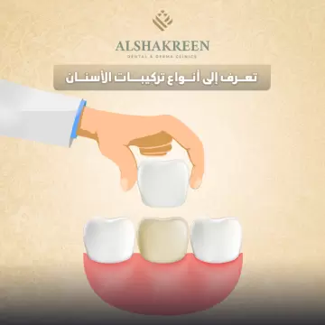 أنواع تركيبات الأسنان