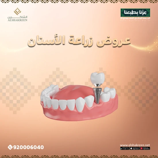 خصم اليوم الوطني  - عروض زراعة الأسنان