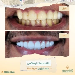 <p>حالة عدسات ايماكس</p>