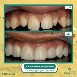 <p>ابتسامة هوليوود بعدسات الإيماكس</p>