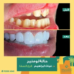 <p>حالة لومنير</p>