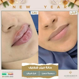 <p>حالة فيلر شفايف<br />
&nbsp;</p>