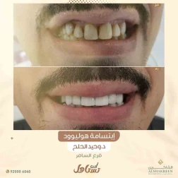 <p>إبتسامة هوليوود</p>

<p><br />
اهم عروض الاسنان&nbsp;</p>

<p><a href="https://alshakreen.net/public/ar/offers/Dental-offers?page=2">ابتسامة هوليود&nbsp;</a></p>

<p><a href="https://alshakreen.net/public/ar/offers/Dental-offers?page=1">تنظيف الاسنان</a></p>
