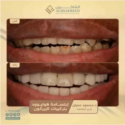<p><a href="https://alshakreen.net/public/ar/offers/Dental-offers?page=1">إبتسامة هوليوود بتركيبات الزيركون</a><br />
&nbsp;</p>