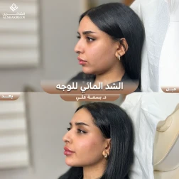 <p>الشد المائي للوجه&nbsp;</p>