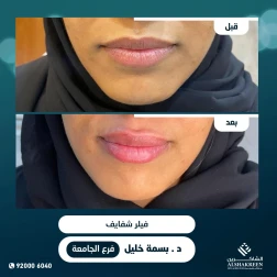 <p><a href="https://alshakreen.net/public/ar/offers/%D8%B9%D8%B1%D9%88%D8%B6-%D8%A7%D9%84%D8%AA%D8%AC%D9%85%D9%8A%D9%84-22?page=2">حالة فيلر شفايف</a><br />
&nbsp;</p>