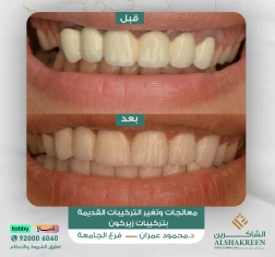 <p>معالجات وتغير التركيبات القديمة بتركيبات زيركون</p>
