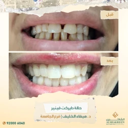 <p>حالة دايركت فينير</p>