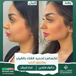 <p>&nbsp;</p>

<p>تكساس تحديد الفك بالفيلر وكنتور الخد</p>