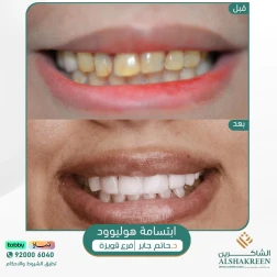 <p>ابتسامة هوليوود</p>