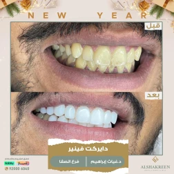 <p>&nbsp;</p>

<p>دايركت فينير</p>