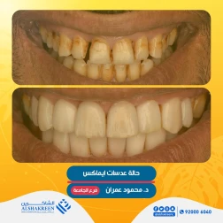 <p>حالة عدسات ايماكس<br />
&nbsp;</p>