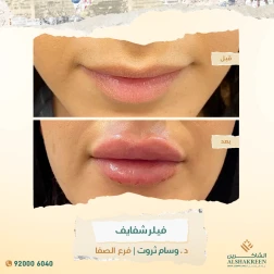 <p>يعتبر الكولاجين أيضاً من المواد الشائع استخدامها في تكبير الشفاه ولكنه أصبح مؤخراً أقل استعمالاً بسبب توفر خيارات جديدة أكثر أماناً و تأثيرها يدوم لفترة أطول</p>

<p>&nbsp;</p>