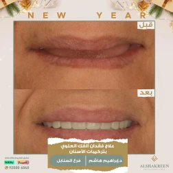<p>&nbsp;</p>

<p>علاج فقدان الفك العلوي بتركيبات الأسنان</p>