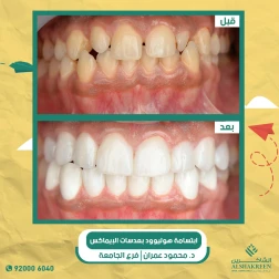 <p>ابتسامة هوليوود بعدسات الإيماكس</p>