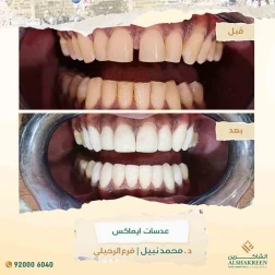 <p>عدسات ايماكس</p>