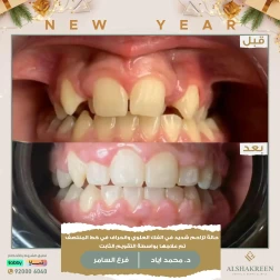 <p>حالة تزاحم شديد في الفك العلوي وانحراف في خط المنتصف تم علاجها بواسطة التقويم الثابت</p>