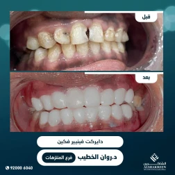 <p><a href="https://alshakreen.net/public/ar/offers/Dental-offers?page=1">دايركت فينيير فكين</a></p>