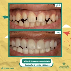 <p>ابتسامة هوليوود بعدسات الإيماكس</p>