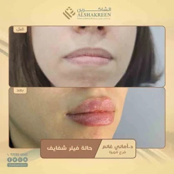 <p><a href="https://alshakreen.net/public/ar/offers/%D8%B9%D8%B1%D9%88%D8%B6-%D8%A7%D9%84%D8%AA%D8%AC%D9%85%D9%8A%D9%84-22">حالة فيلر شفايف</a><br />
&nbsp;</p>