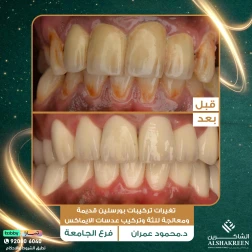 <p>تغيرات تركيبات بورسلين قديمة ومعالجة للثة وتركيب عدسات الايماكس</p>

<p>&nbsp;</p>