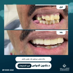 <p><a href="https://alshakreen.net/public/ar/offers/Dental-offers?page=2">حاله تركيب زيركون فك علوي كامل</a></p>