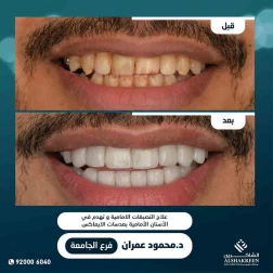 <p>علاج التصبغات الامامية وتهدم في الأسنان الأمامية بعدسات الايماكس</p>