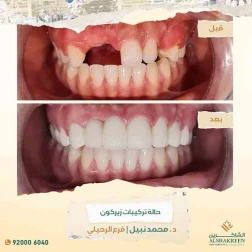 <p>حالة تركيبات زيركون</p>