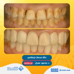 <p><a href="https://alshakreen.net/public/ar/offers/Dental-offers">حالة عدسات ايماكس</a><br />
&nbsp;</p>