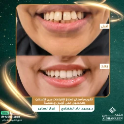 <p>&nbsp;</p>

<p>تقويم أسنان لعلاج الفراغات بين الأسنان والحصول على أجمل إبتسامة</p>